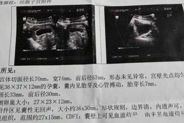 广州失独家庭代孕之路|月经正常卵巢不一定好，泰国试管不一定成功