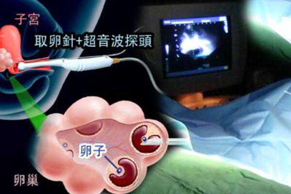广州供卵试管婴儿医院,广州供卵自怀费用明细-代怀妈妈