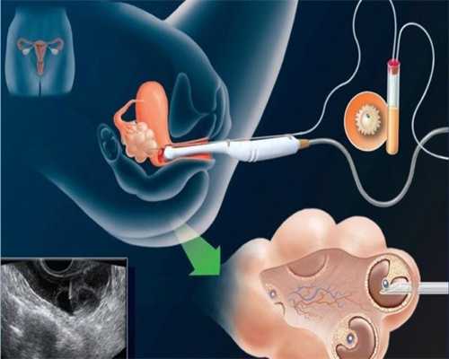 广州代怀孕零首付:子宫肌瘤可能是孕囊吗