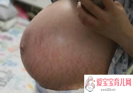 怀孕需要预防娠纹吗妊娠纹对宝宝有影响吗