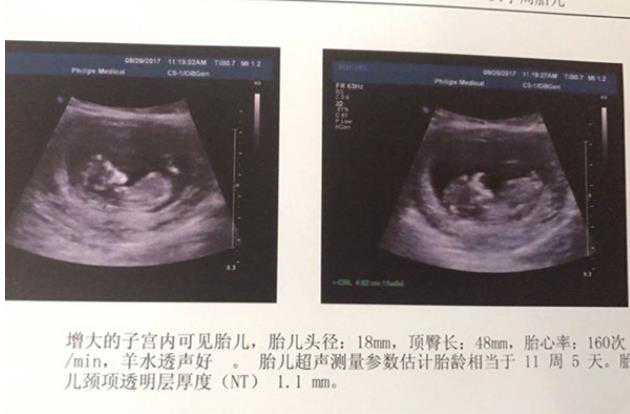广州代怀宝宝价格 广州医院做试管婴儿费用价格贵吗? ‘双顶径和心率看男女’